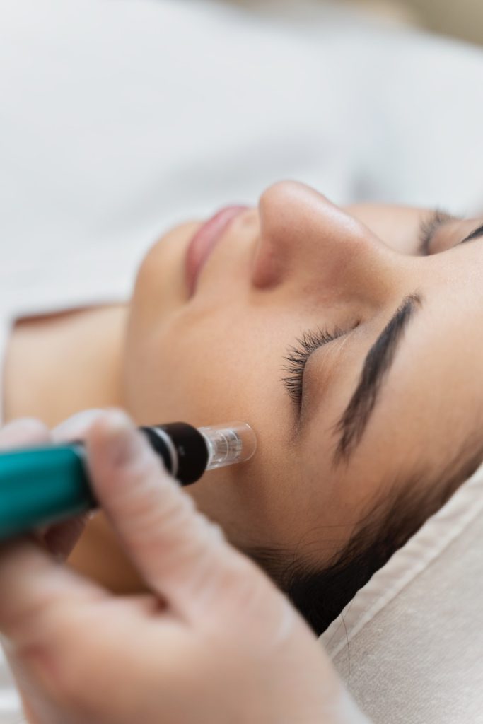 4 vampire facial dr alastair clark sandton aesthetic institute aug 2025