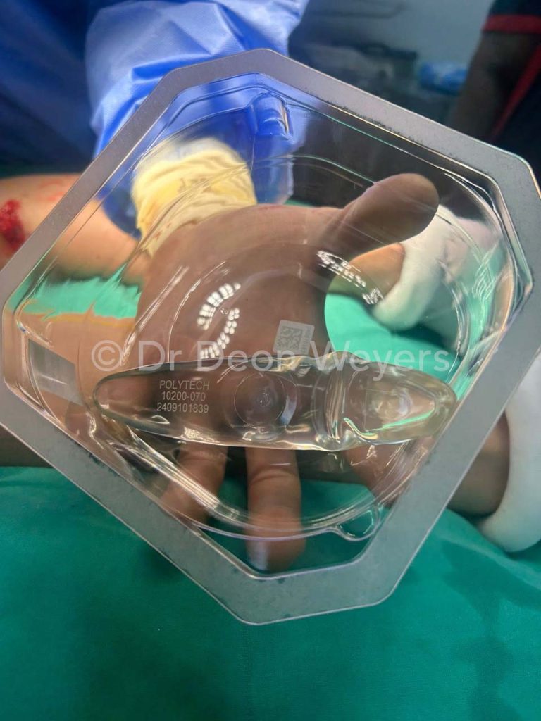 Calf augmentation implant