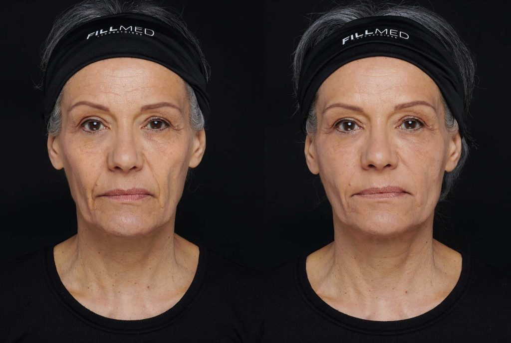 15 fillmed bionutrilift and bionutrilips sep 2025
