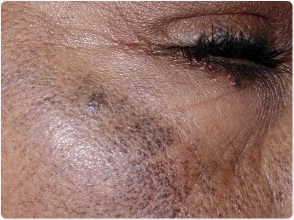 3 endogenous ocronosis dr irshad essack feb 2026.jpg copy