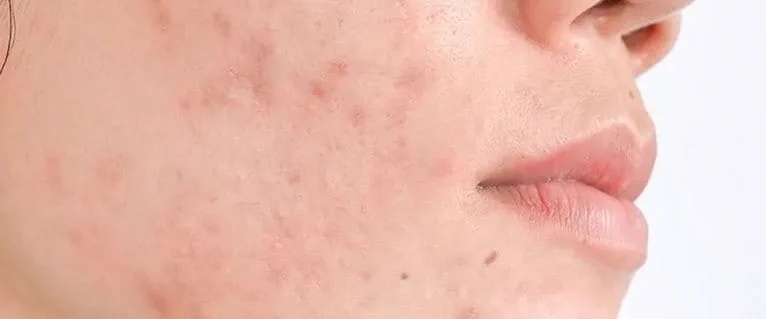 5 Acne Induced Hyperpigmentation dr irshad essack feb 2026 copy