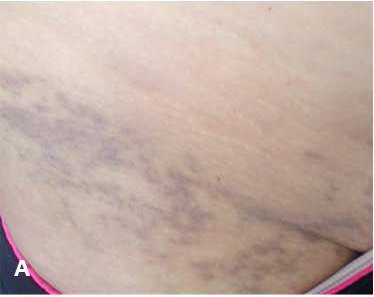 6 Lichen Planus Pigmentosus Ashy Dermatosis dr irshad essack feb 2026