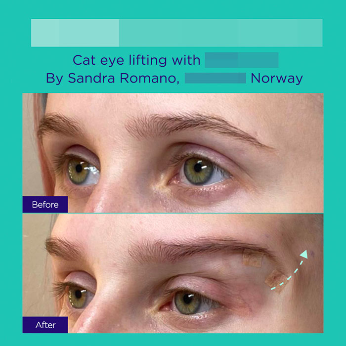 10 GA active mint lift pdo threads mar 2026