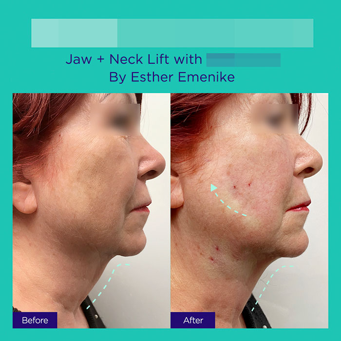 11 GA active mint lift pdo threads mar 2026