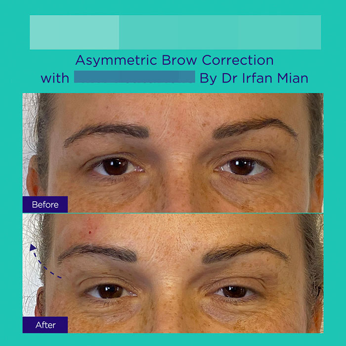 13 GA active mint lift pdo threads mar 2026