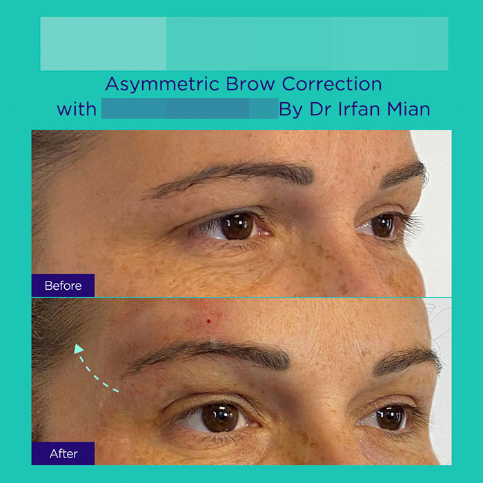 14 GA active mint lift pdo threads mar 2026