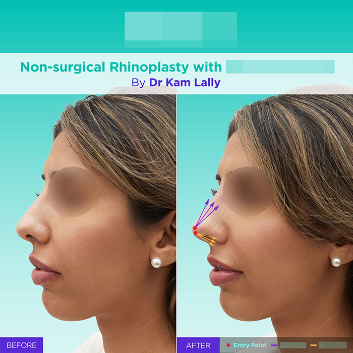 16 GA active mint lift pdo threads mar 2026