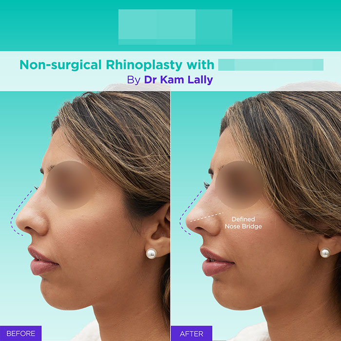 17 GA active mint lift pdo threads mar 2026