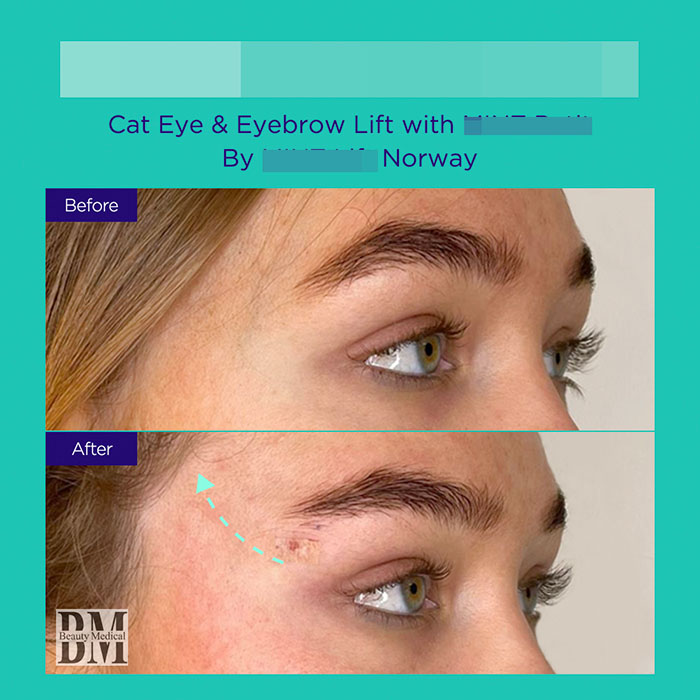 4 GA active mint lift pdo threads mar 2026