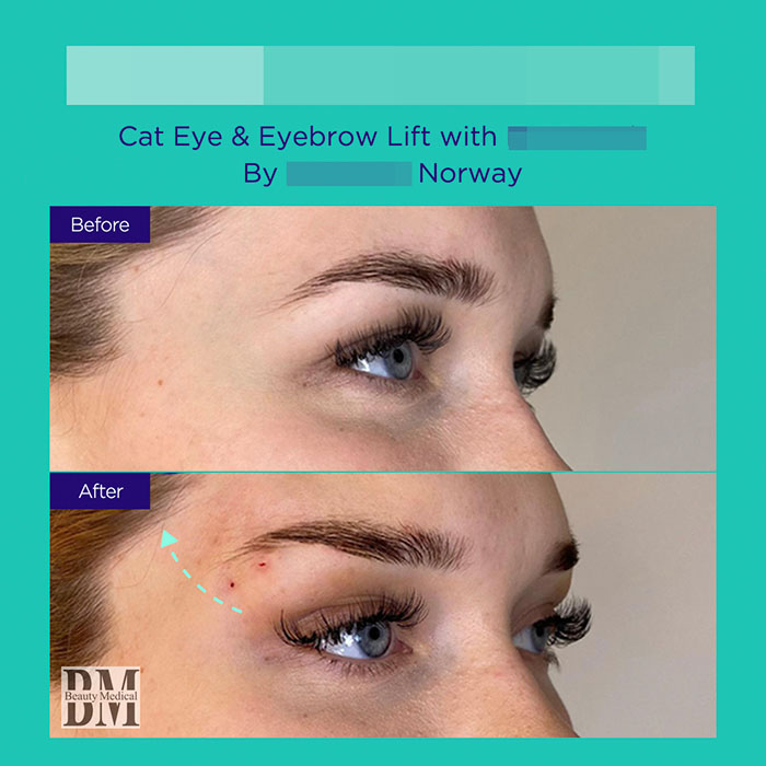 5 GA active mint lift pdo threads mar 2026