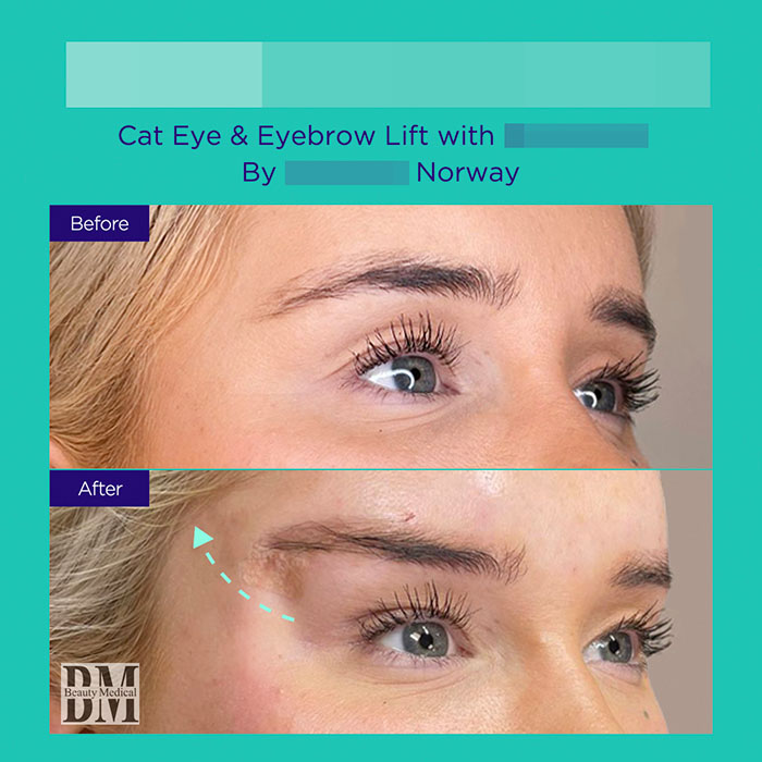 6 GA active mint lift pdo threads mar 2026