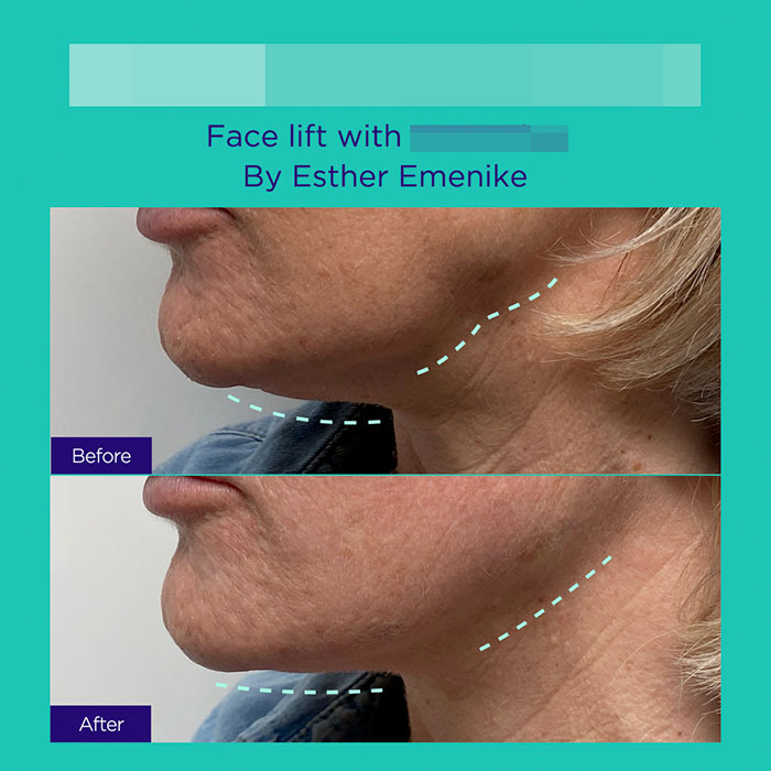 7 GA active mint lift pdo threads mar 2026