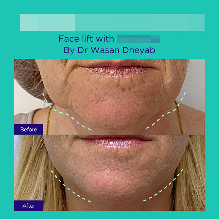 8 GA active mint lift pdo threads mar 2026