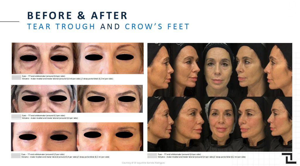 8 fillmed art filler eyes apr 2026