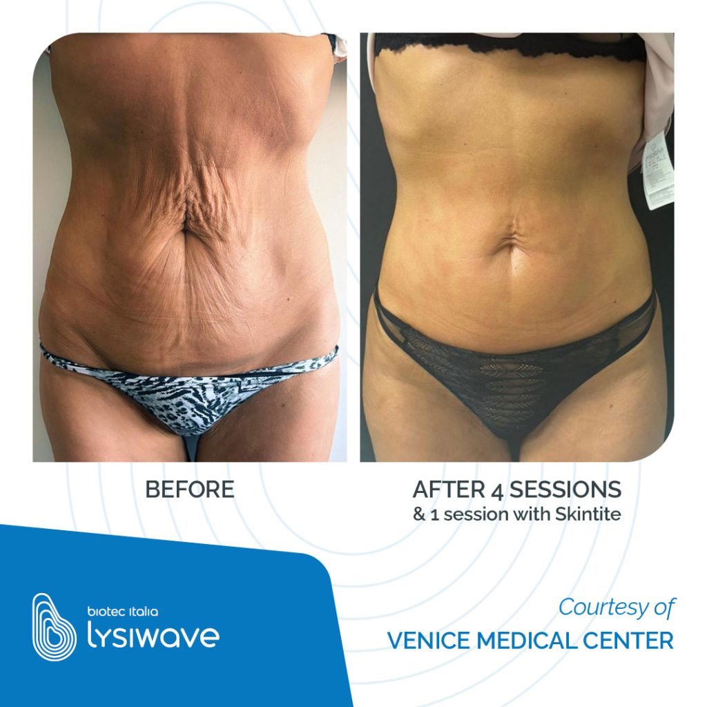 5 medi aesthetic solutions LYSIWAVE may 2026