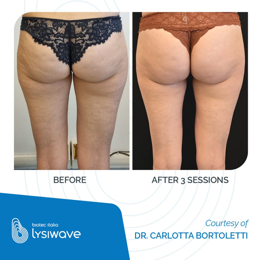 6 medi aesthetic solutions LYSIWAVE may 2026