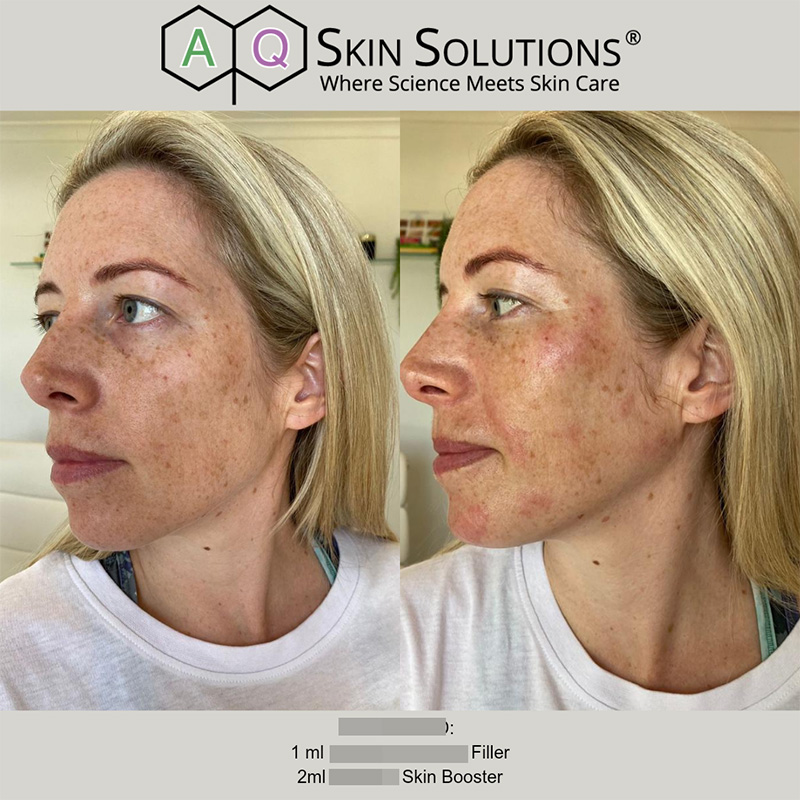 18 retouch ultradeep Kirst2 aq skin solutions regenerative treatments aug 2026