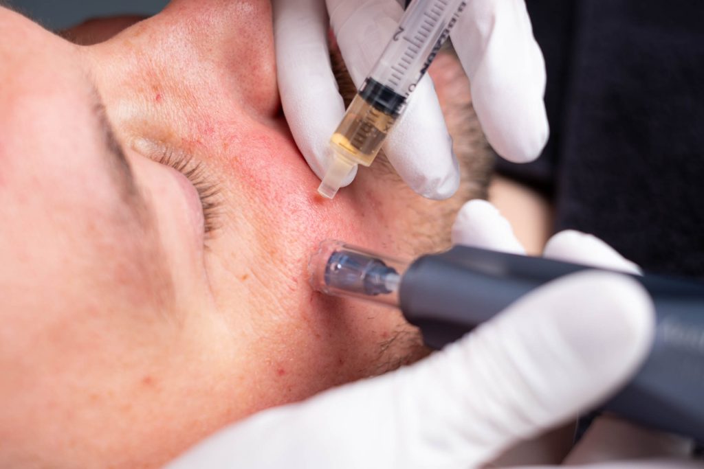 8 d a works miconeedling treatment needlingpens d a blue sky international matrix needling sep 2026