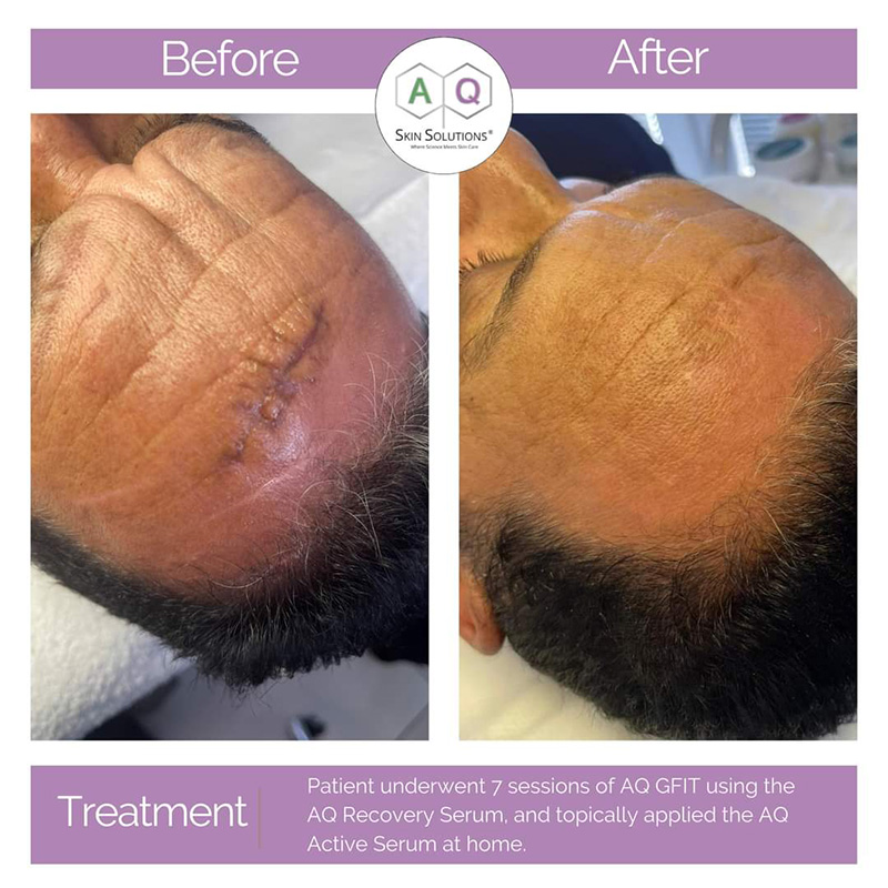 9 Pulse GFIT Scarring aq skin solutions regenerative treatments aug 2026