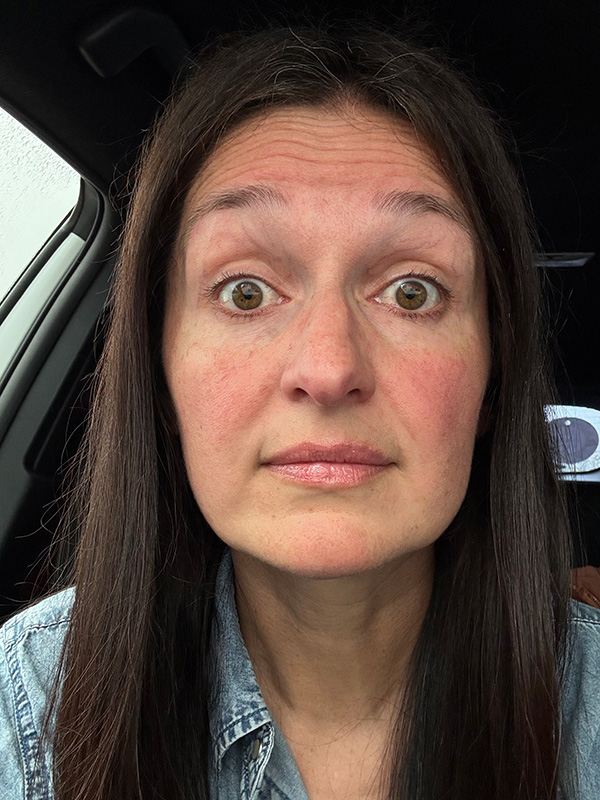 10 BEFORE forehead lines kelli clifton botox dr michelle hutton