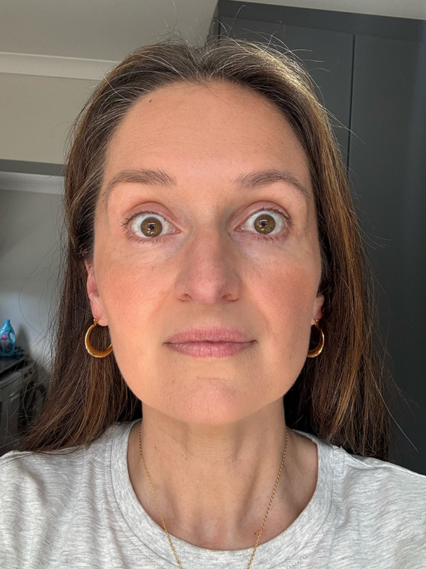 11 AFTER forehead lines kelli clifton botox dr michelle hutton
