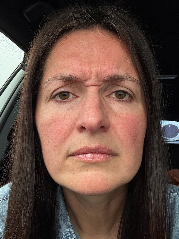 12 BEFORE frown lines kelli clifton botox dr michelle hutton