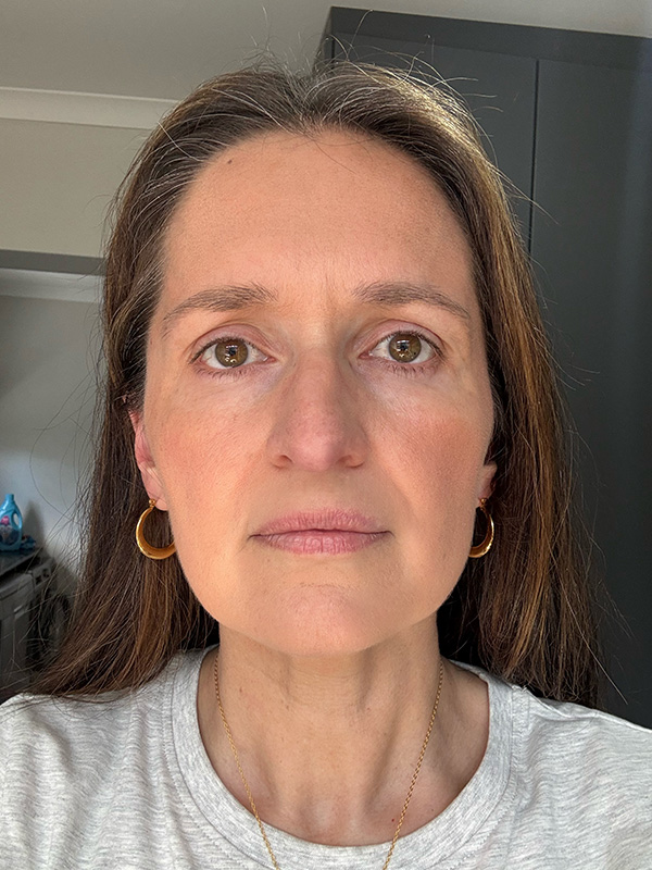 13 AFTER frown lines kelli clifton botox dr michelle hutton